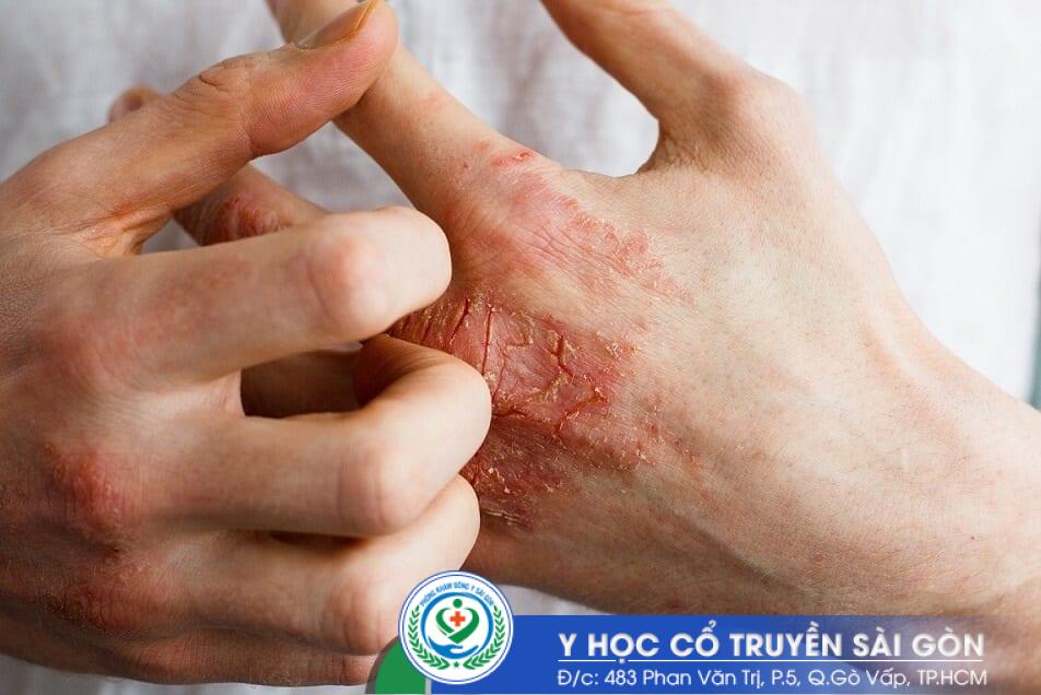 Bệnh chàm là căn bệnh viêm da gây ngứa, khô và đóng vảy trên da